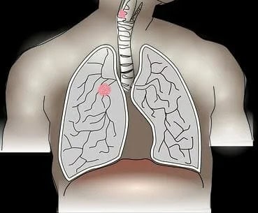 3 bahan alami mencegah gejala kanker paru-paru