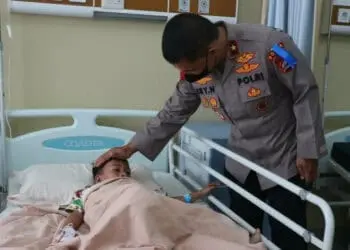Gelar Baksos, Polda Banten Operasi Gratis 15 Orang Penderita Bibir Sumbing