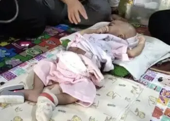 Kondisi bayi yang tak memiliki anus, sedang terbaring di kediamannya, Rabu (31/8/2022). (ISTIMEWA)