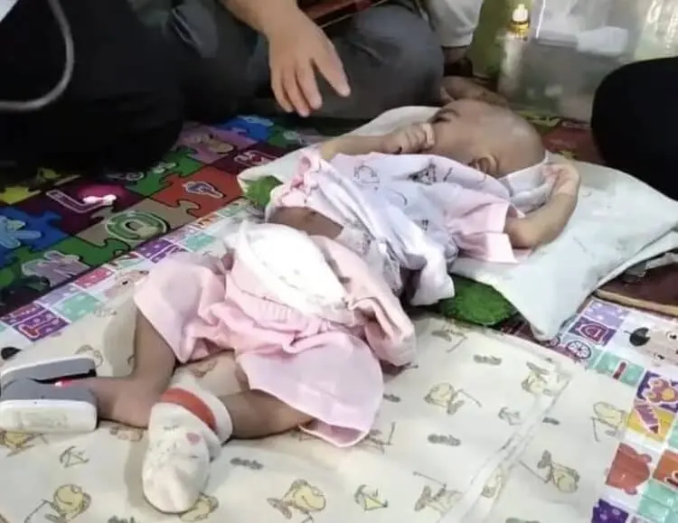 Malang, Seorang Bayi di Pandeglang Lahir Tanpa Anus, Kini Butuh Uluran Tangan Dermawan