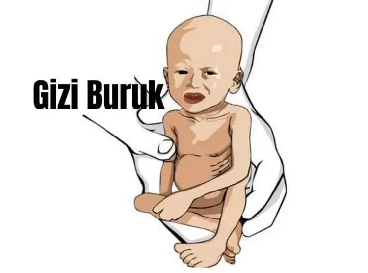 Astaghfirullah, 1.390 Anak di Pandeglang Menderita Gizi Buruk dan 3.708 Anak Gizi Kurang