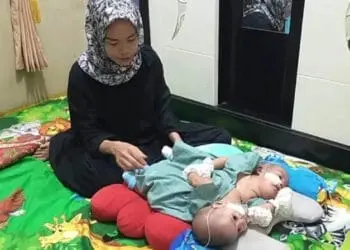 Terkendala Biaya Operasi Pemisahan, Bayi Kembar Siam Asal Lebak Ini Perlu Uluran Tangan