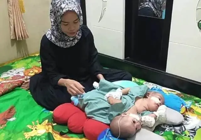 Terkendala Biaya Operasi Pemisahan, Bayi Kembar Siam Asal Lebak Ini Perlu Uluran Tangan