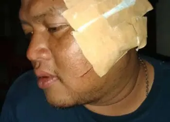 Habis Bacok Temannya Sendiri, Pelaku Kabur dari Pandeglang, Begini Kondisi Korban Terkini