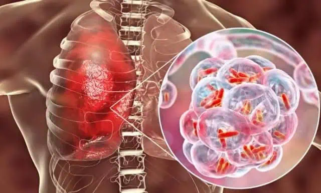 Pneumonia Misterius Merebak di China, Dinkes Kota Tangerang Minta Masyarakat Jangan Panik