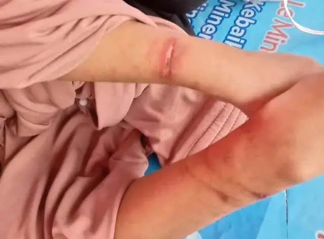 Mengenaskan, Diduga Dianiaya Orang Tua Tiri, Remaja di Cikokol dengan Kondisi Lebam Ditemukan Linglung di Pinggir Jalan