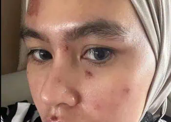 Wajah Dan Lidah Melepuh, Begini Penjelasan Kartika Putri Ungkap Penyebabnya