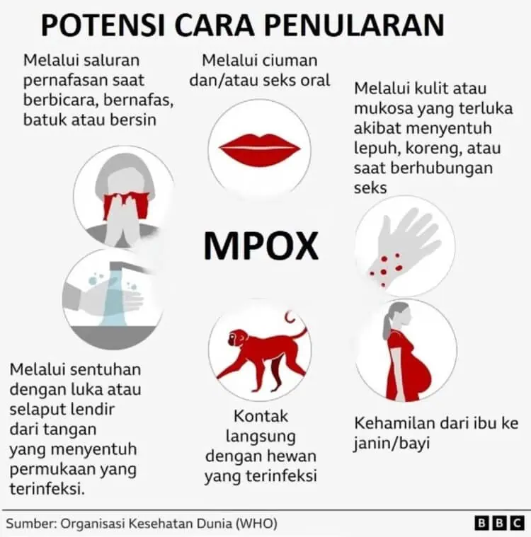 Simak ya, Ini Perbedaan Mpox vs Covid-19 !