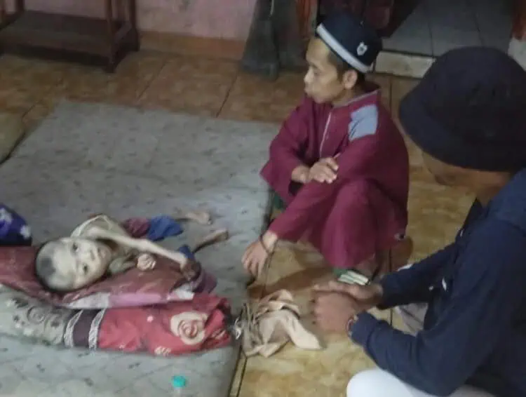 8 Tahun Derita Gizi Buruk, Kondisi Dudu Warga Pandeglang Semakin Memperihatinkan