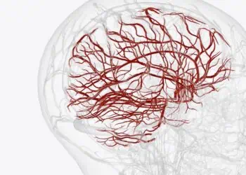 Digital Subtraction Angiography, Bantu Dokter Deteksi Jalur Macet di Pembuluh Darah Otak